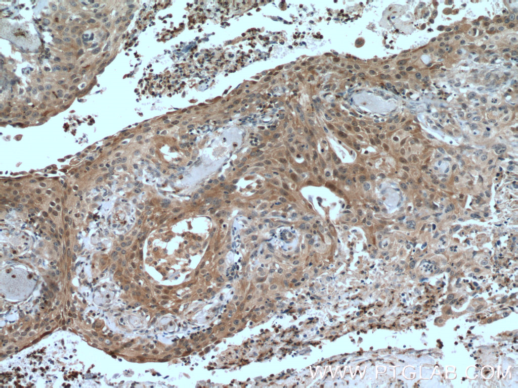 IHC staining of human cervical cancer using 51066-1-AP