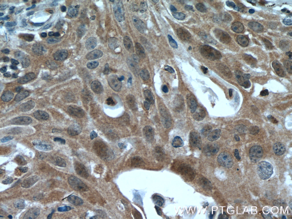 IHC staining of human cervical cancer using 51066-1-AP