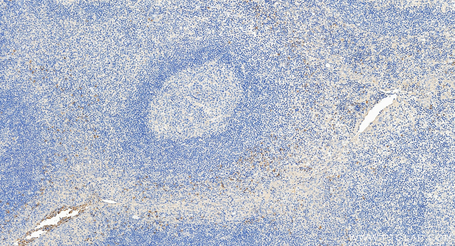 IHC staining of human tonsillitis using 14085-1-AP IHC staining of human tonsillitis using 14085-1-AP