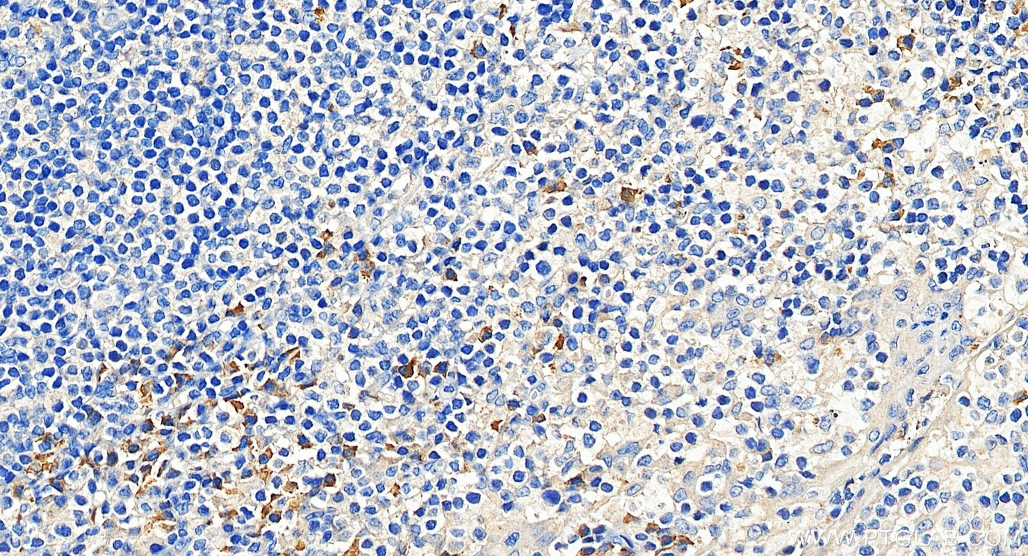 IHC staining of human tonsillitis using 14085-1-AP IHC staining of human tonsillitis using 14085-1-AP