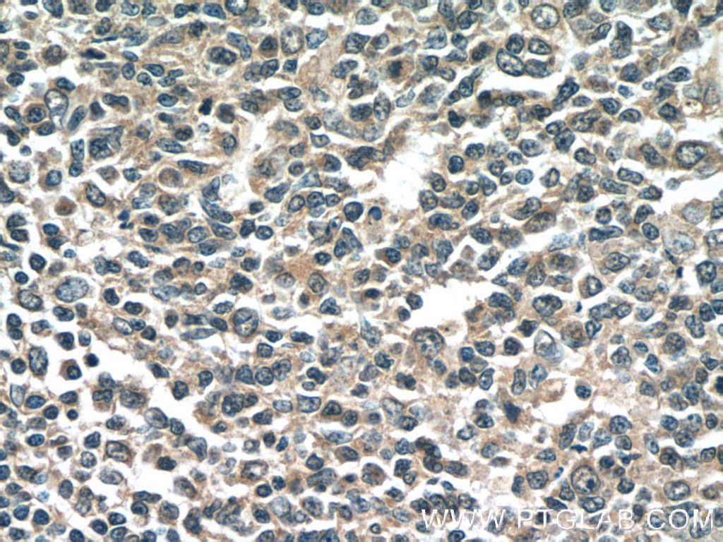 IHC staining of human tonsillitis using 66202-1-Ig