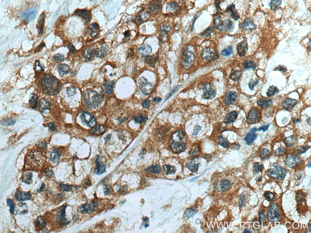 IHC staining of human pancreas cancer using 14380-1-AP