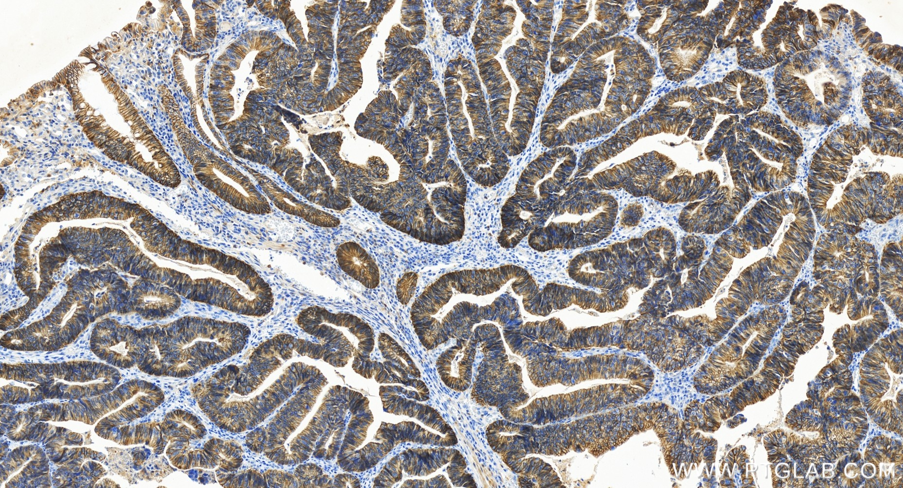 Immunohistochemical analysis of paraffin-embedded human colon cancer tissue slide using 86201-1-RR (NKCC1/SLC12A2 antibody) at dilution of 1:500 (under 20x lens). Heat mediated antigen retrieval with Tris-EDTA buffer (pH 9.0). IHC staining of human colon cancer using 86201-1-RR