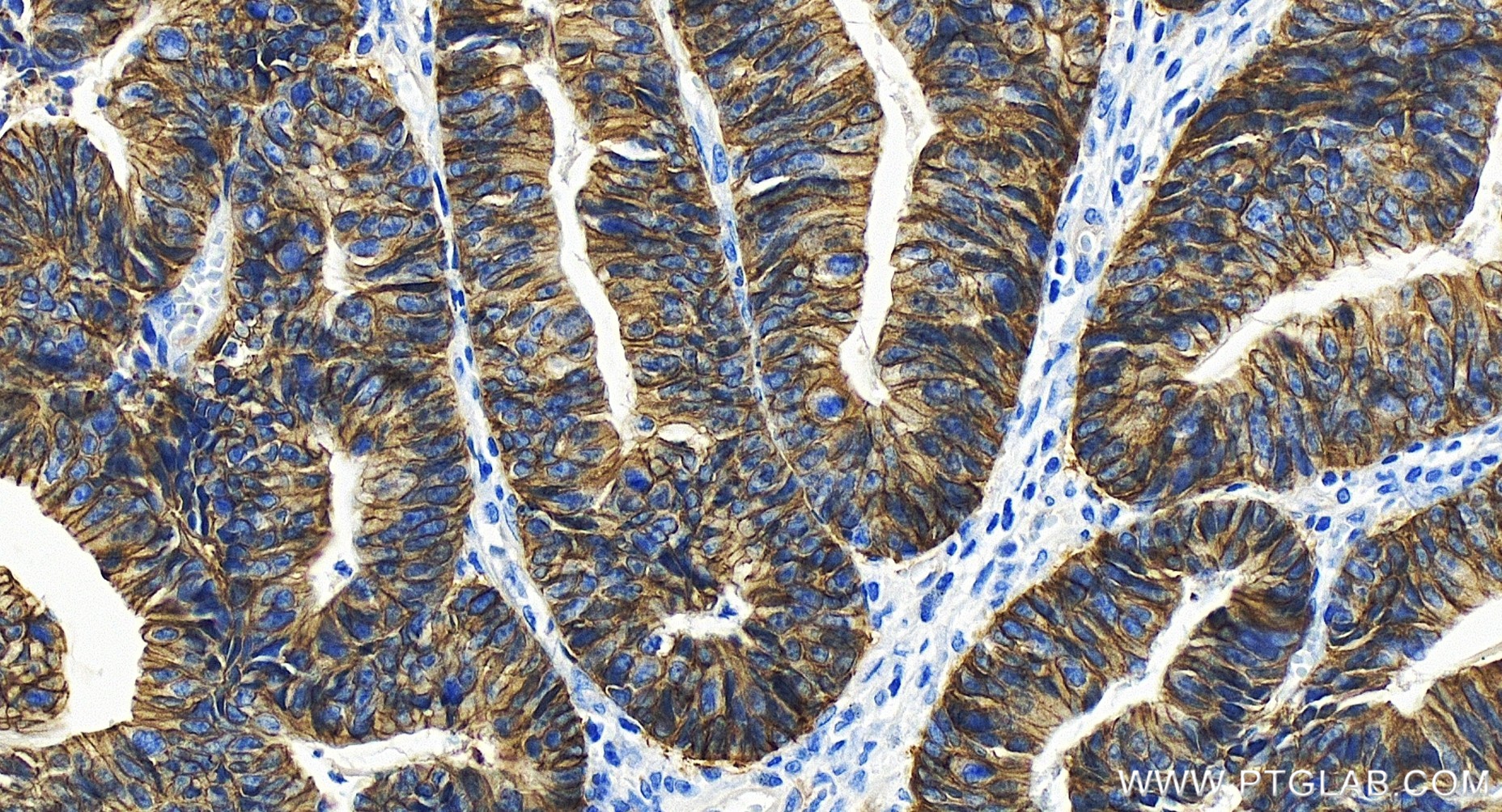 Immunohistochemical analysis of paraffin-embedded human colon cancer tissue slide using 86201-1-RR (NKCC1/SLC12A2 antibody) at dilution of 1:500 (under 20x lens). Heat mediated antigen retrieval with Tris-EDTA buffer (pH 9.0). IHC staining of human colon cancer using 86201-1-RR