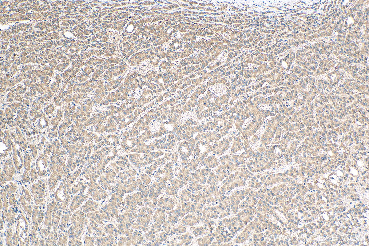 IHC staining of human liver cancer using 19978-1-AP