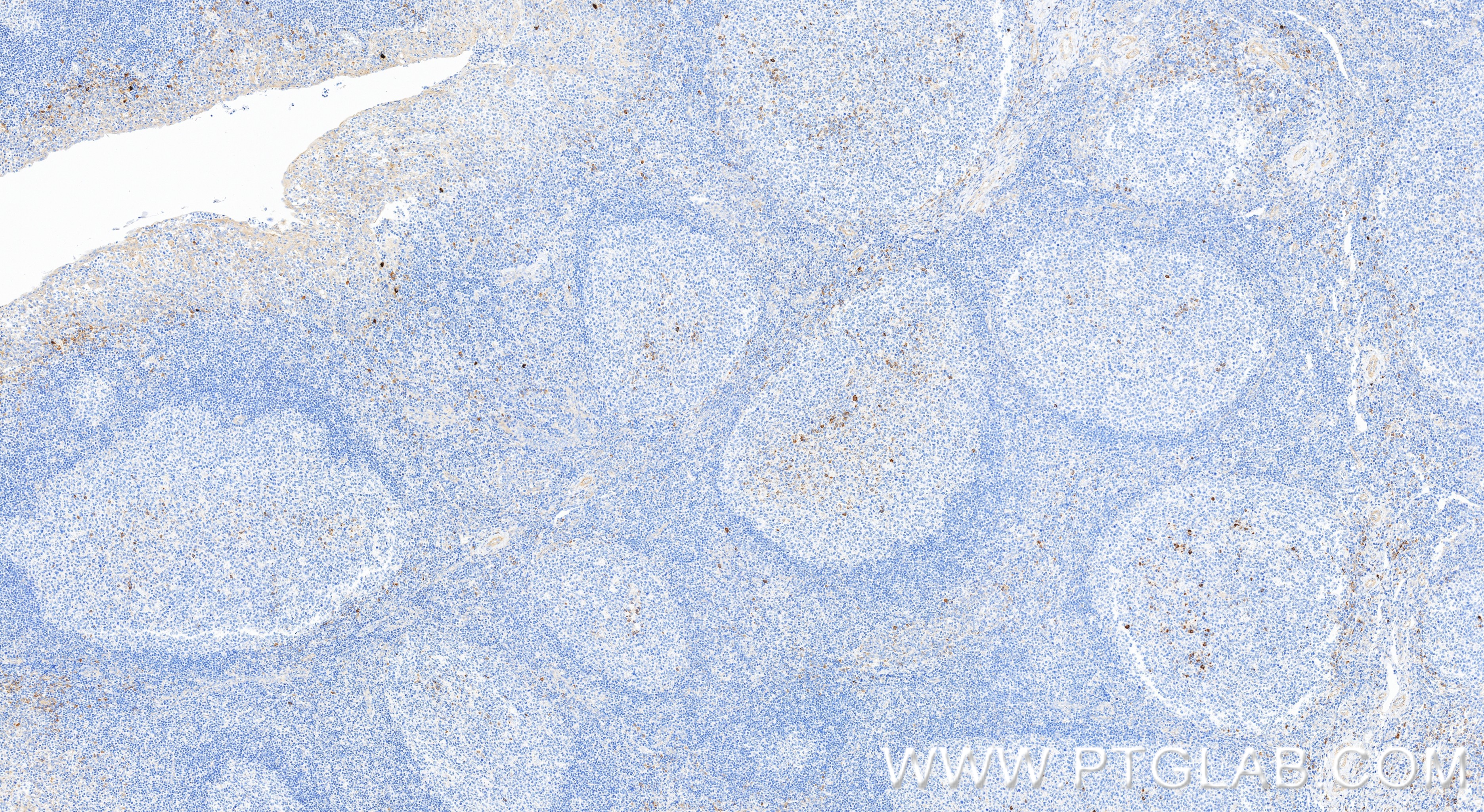 IHC staining of human tonsillitis using 82453-2-RR IHC staining of human tonsillitis using 82453-2-RR