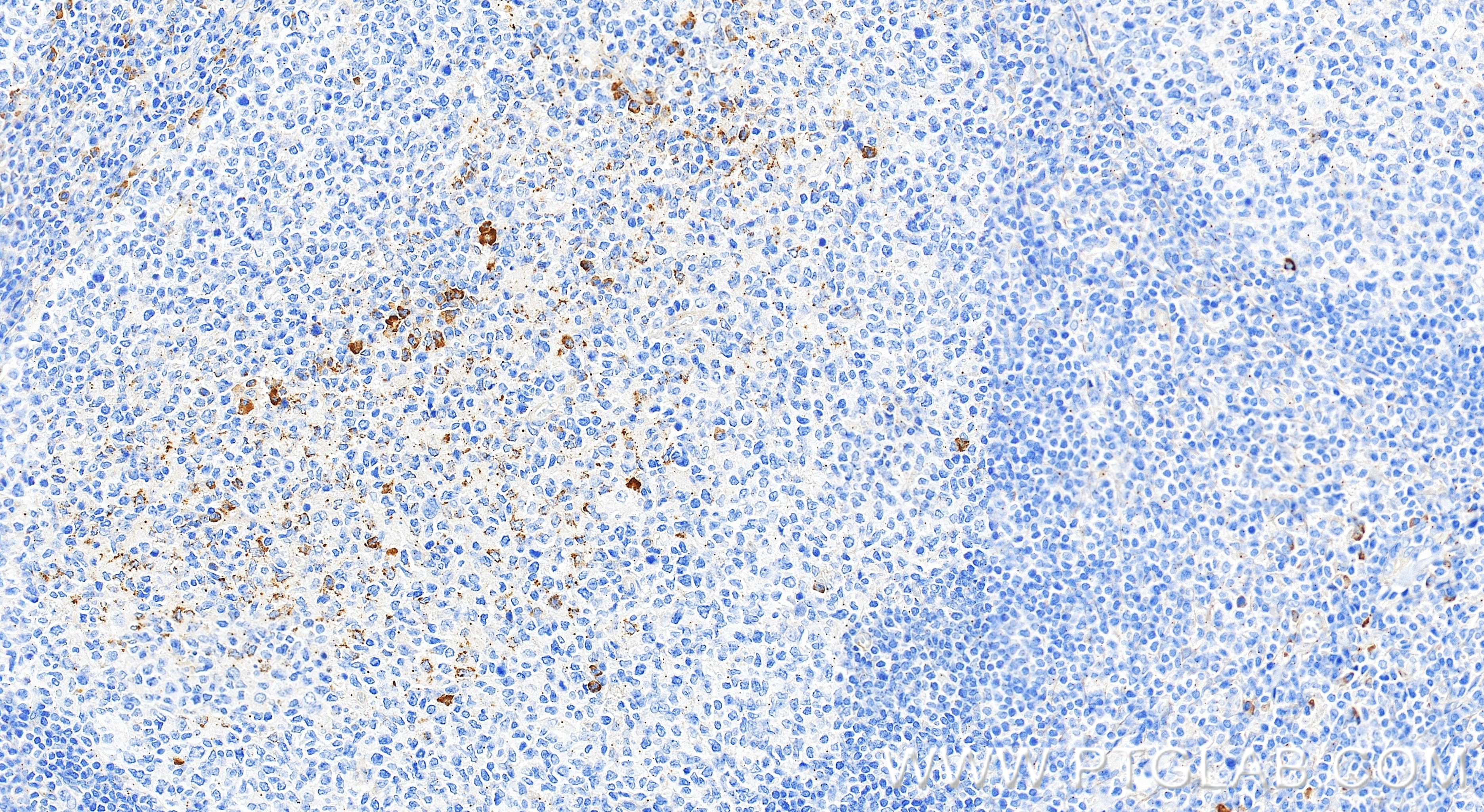 IHC staining of human tonsillitis using 82453-2-RR IHC staining of human tonsillitis using 82453-2-RR