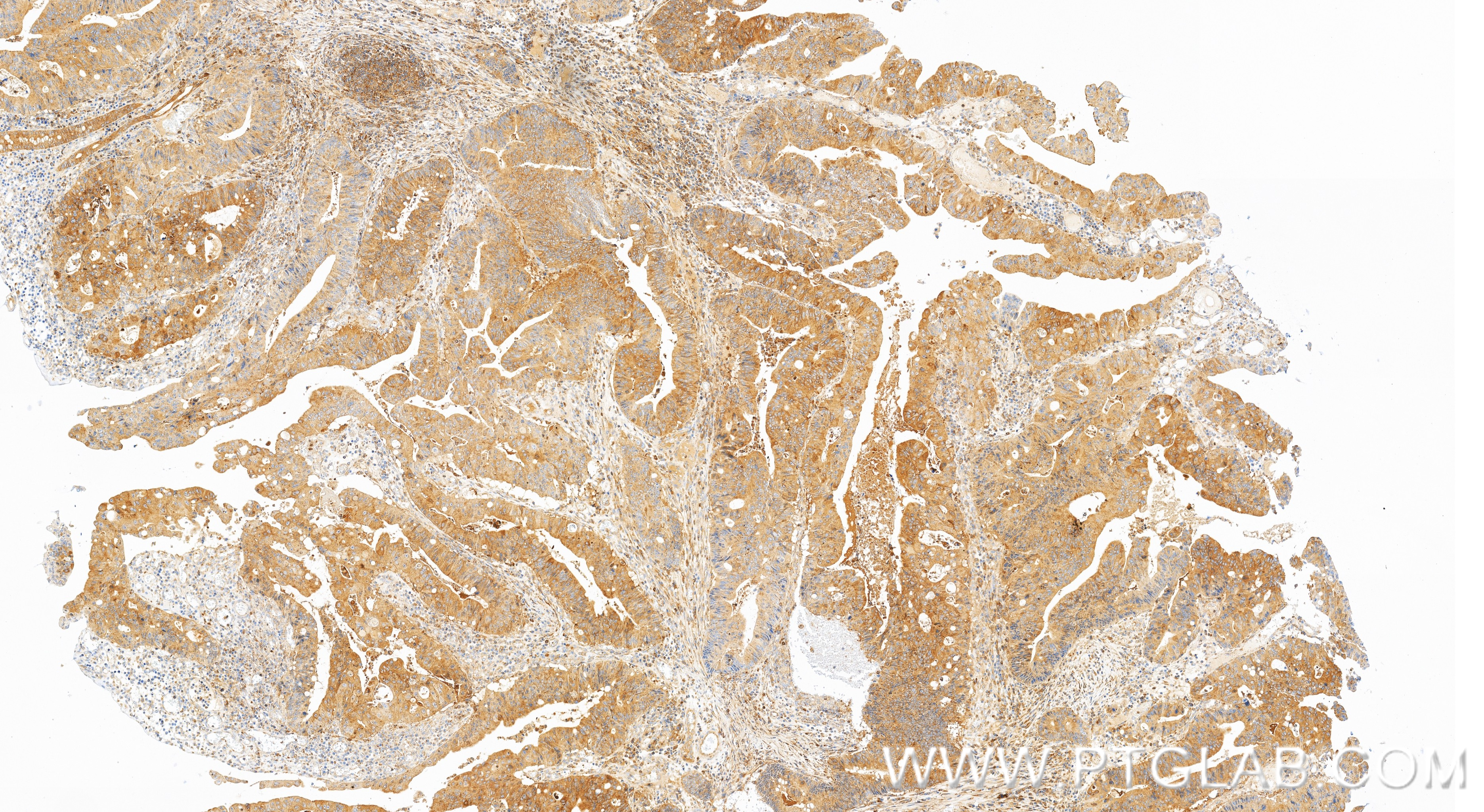 IHC staining of human colon cancer using 83986-2-RR IHC staining of human colon cancer using 83986-2-RR