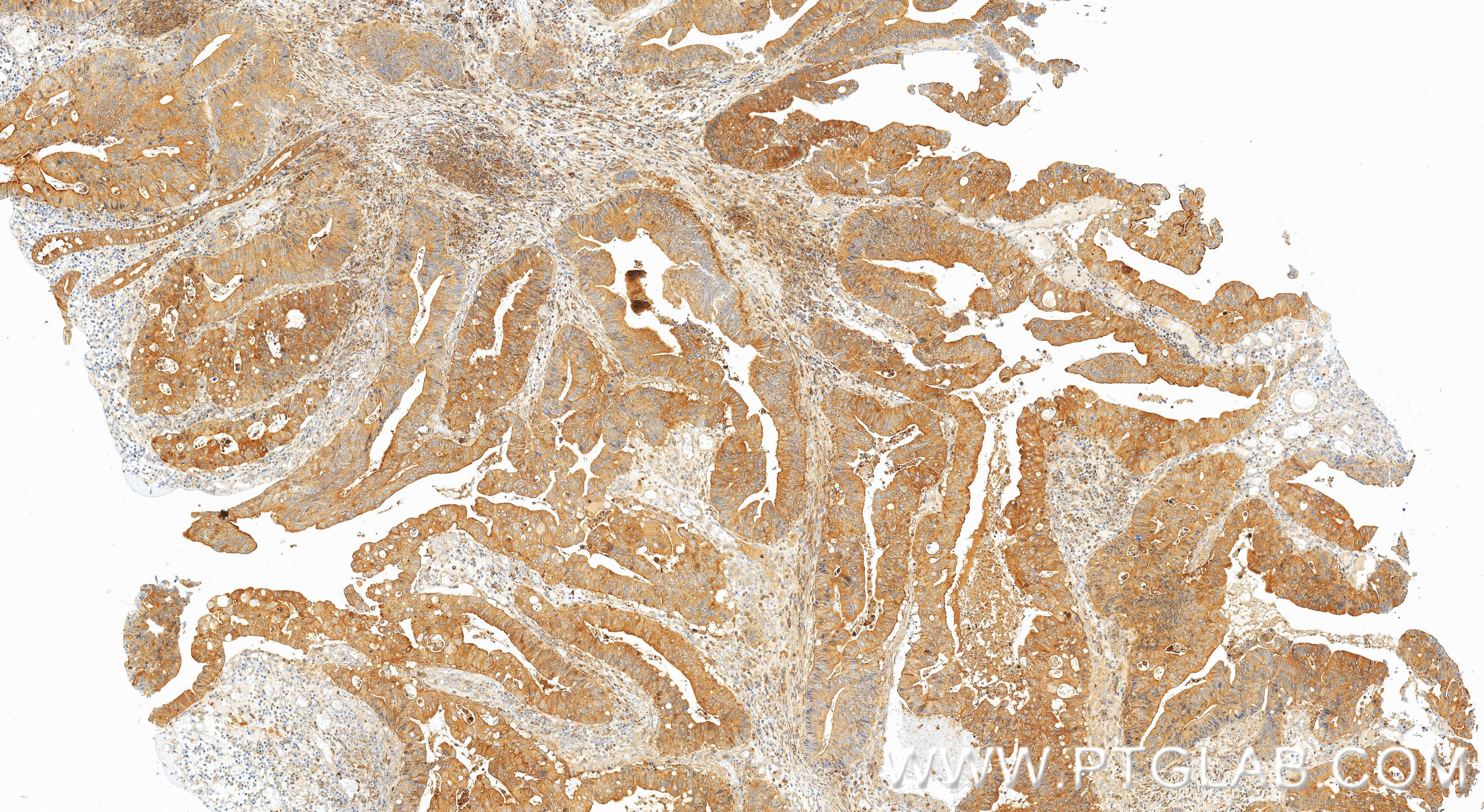 IHC staining of human colon cancer using 83986-5-RR IHC staining of human colon cancer using 83986-5-RR