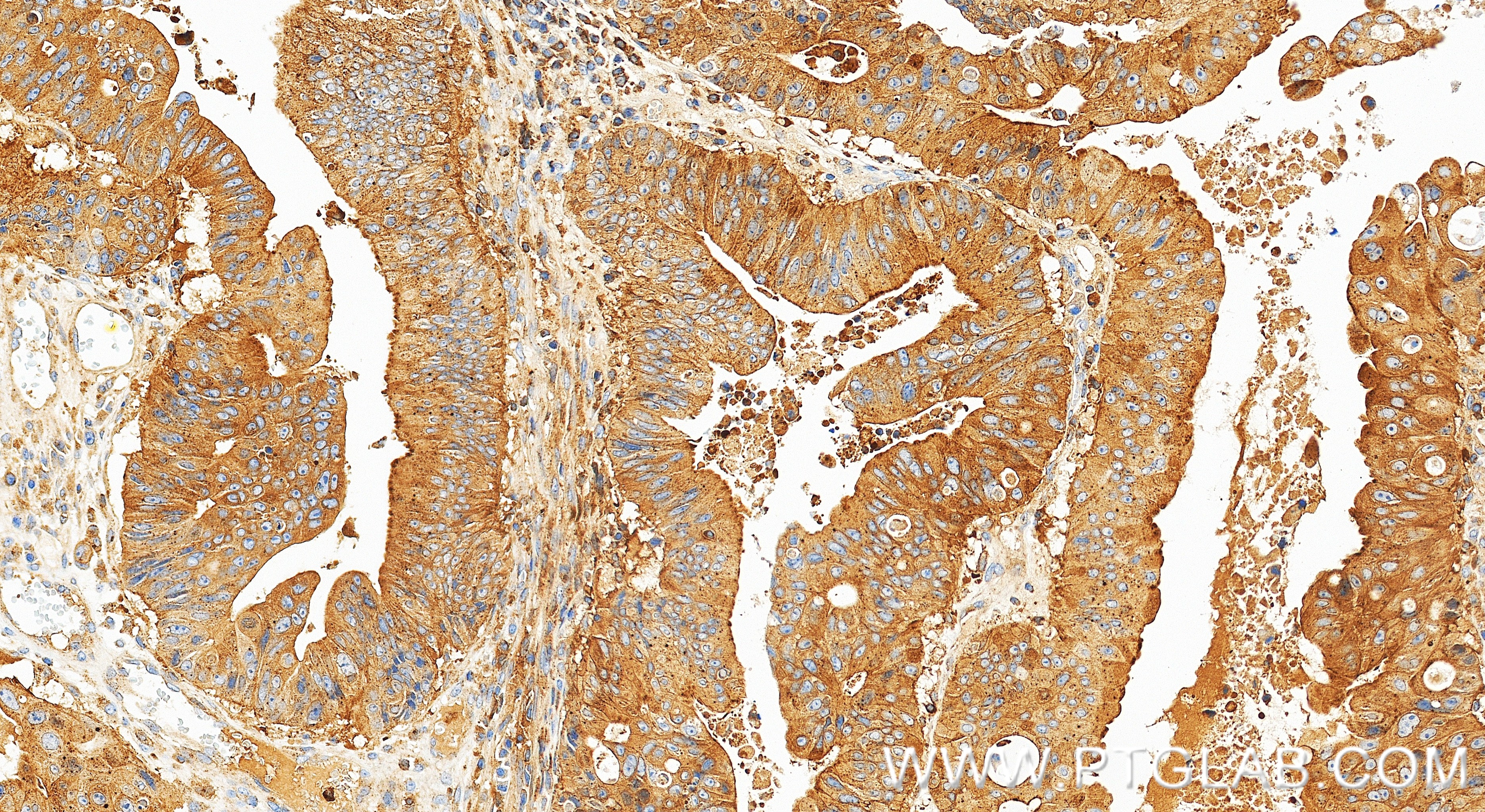 IHC staining of human colon cancer using 83986-5-RR IHC staining of human colon cancer using 83986-5-RR
