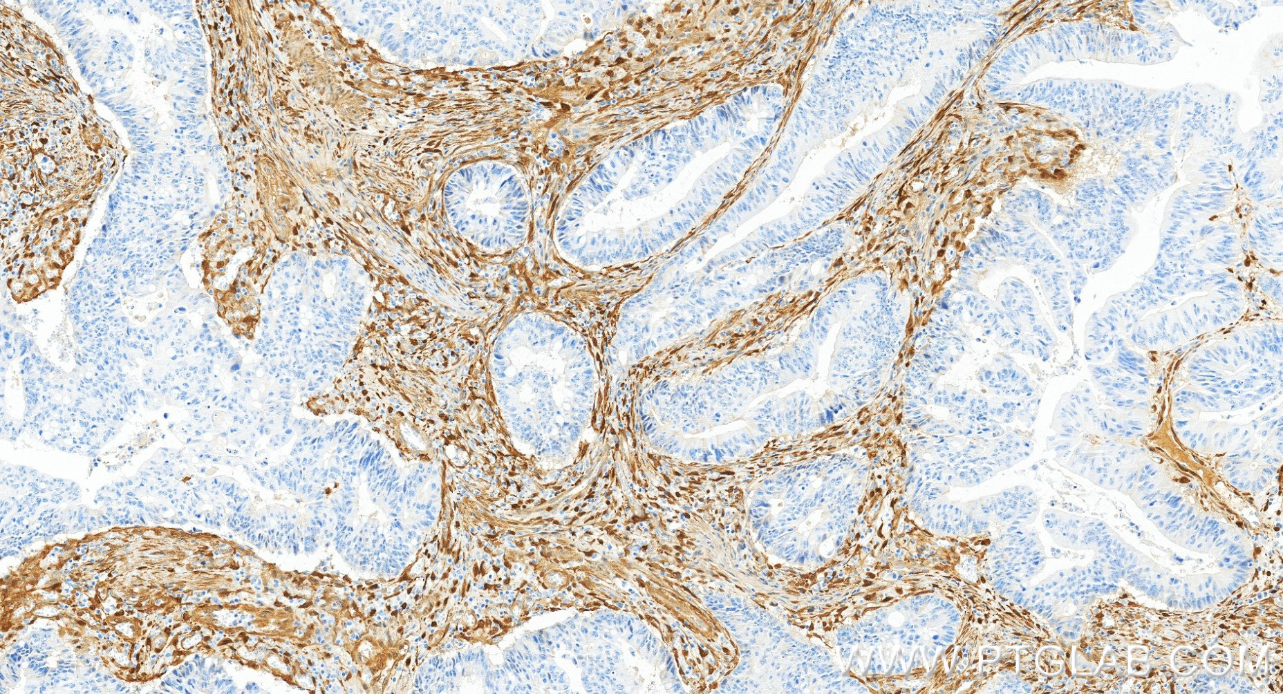 IHC staining of human colon cancer using 84876-9-RR (same clone as 84876-9-PBS) IHC staining of human colon cancer using 84876-9-RR (same clone as 84876-9-PBS)