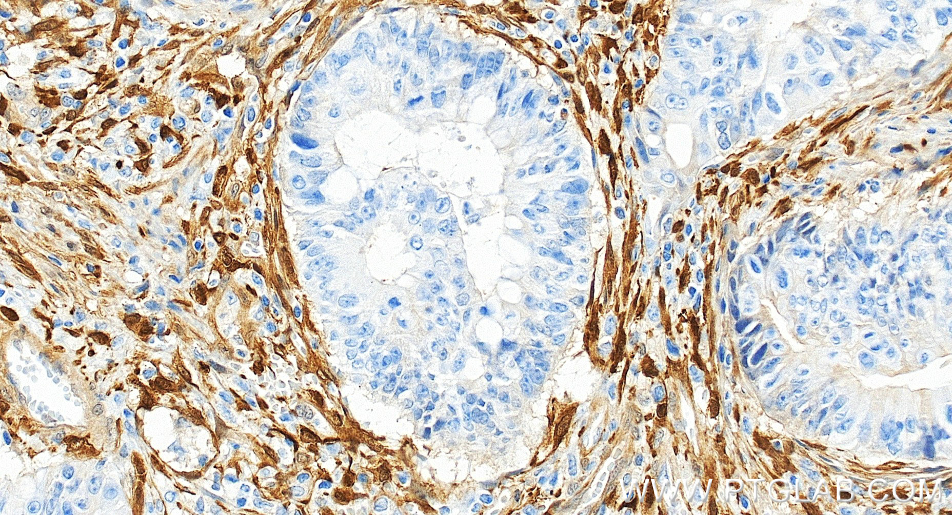 IHC staining of human colon cancer using 84876-9-RR (same clone as 84876-9-PBS) IHC staining of human colon cancer using 84876-9-RR (same clone as 84876-9-PBS)