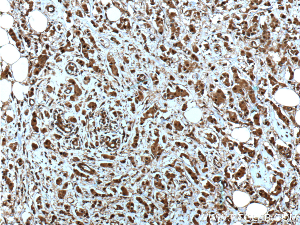 IHC staining of human breast cancer using 66048-1-Ig