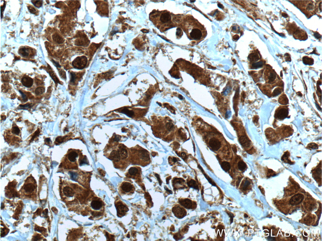 IHC staining of human breast cancer using 66048-1-Ig (same clone as 66048-1-PBS)
