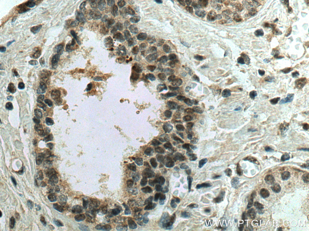 IHC staining of human prostate cancer using 28509-1-AP