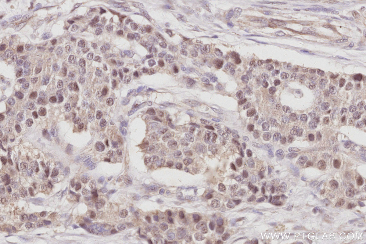 IHC staining of human stomach cancer using 28509-1-AP IHC staining of human stomach cancer using 28509-1-AP