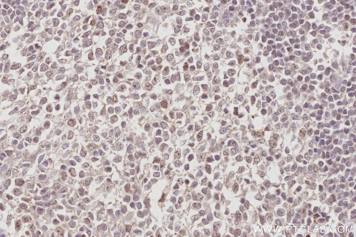 IHC staining of human appendicitis using 28509-1-AP IHC staining of human appendicitis using 28509-1-AP