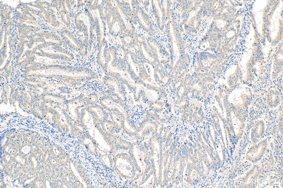 IHC staining of human endometrial cancer using 27430-1-AP