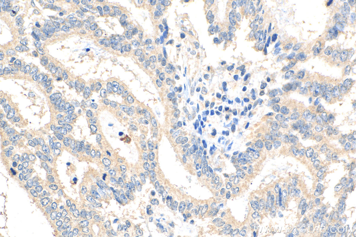 IHC staining of human endometrial cancer using 27430-1-AP