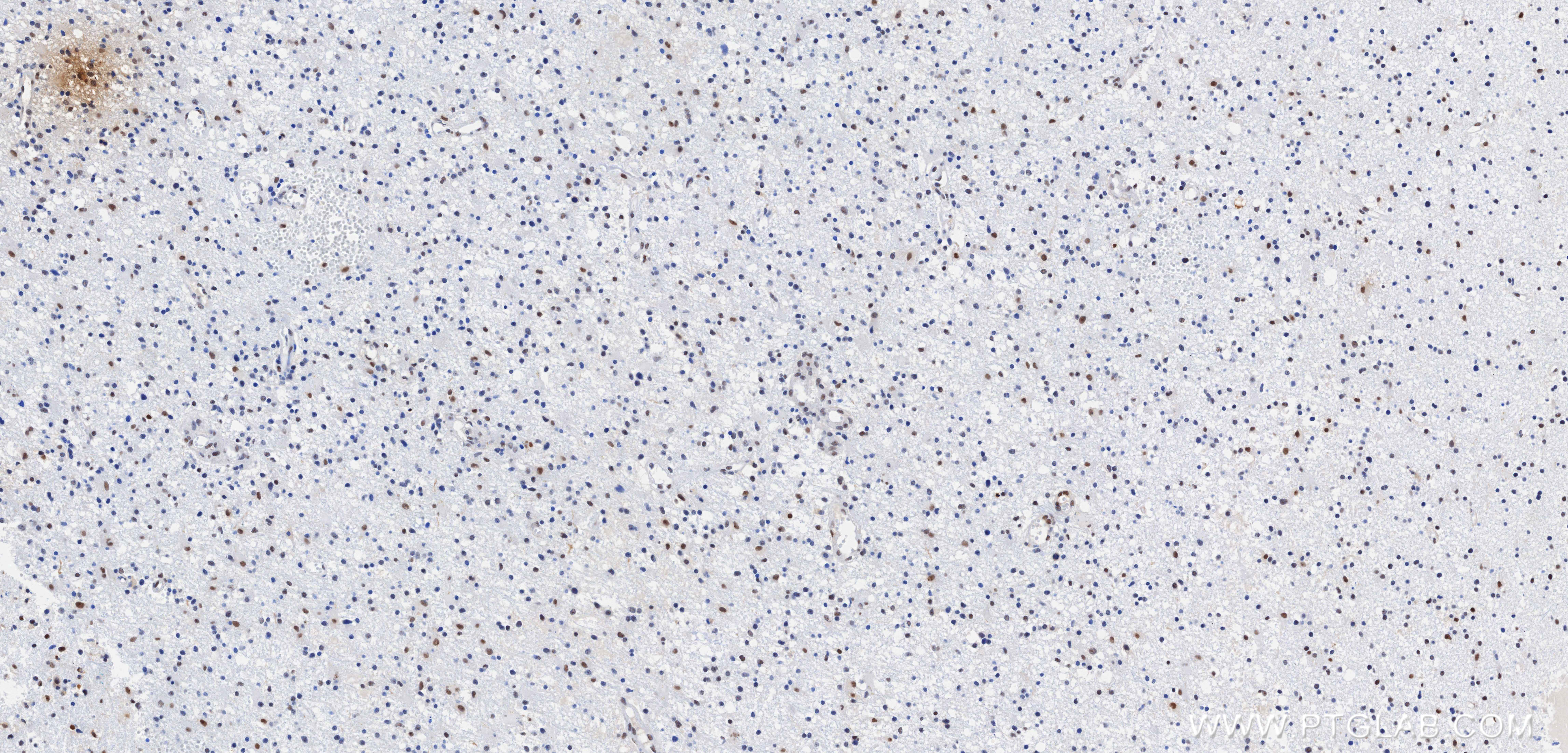 IHC staining of Human brain cancer（Astrocitoma） using 87529-1-RR