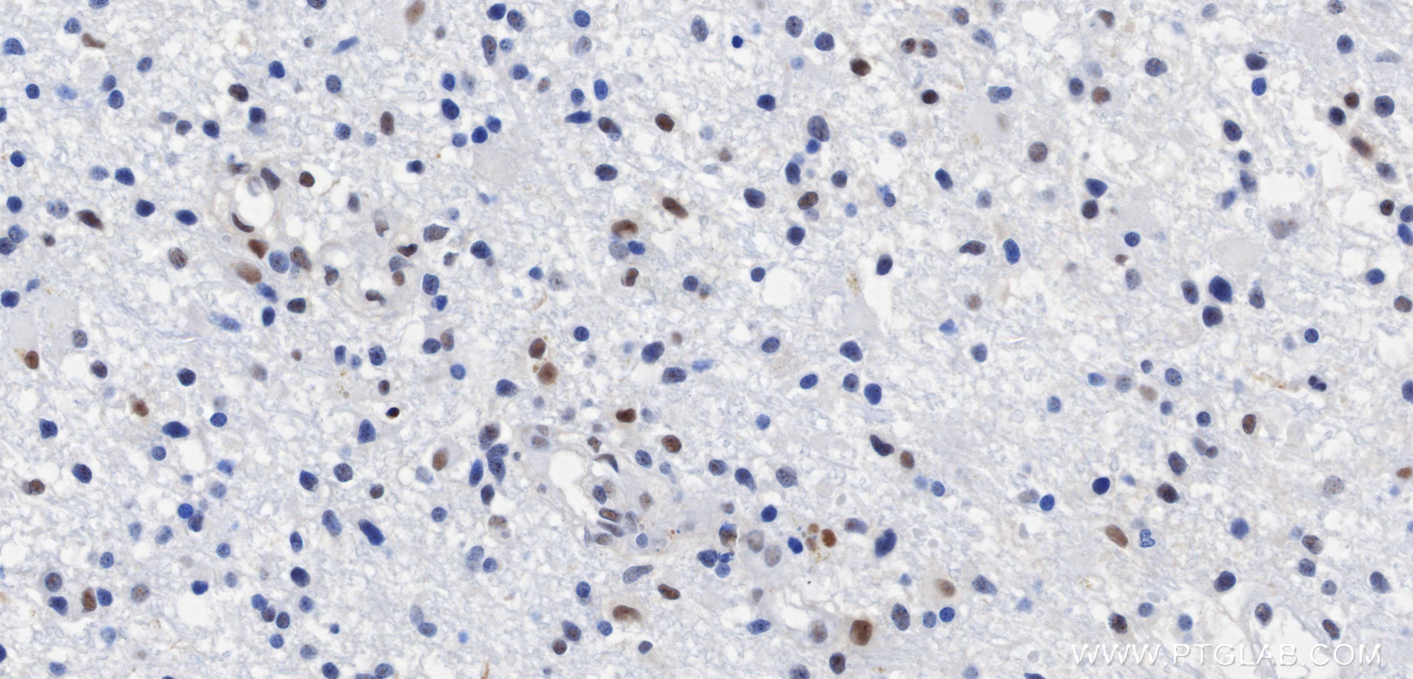 IHC staining of Human brain cancer（Astrocitoma） using 87529-1-RR
