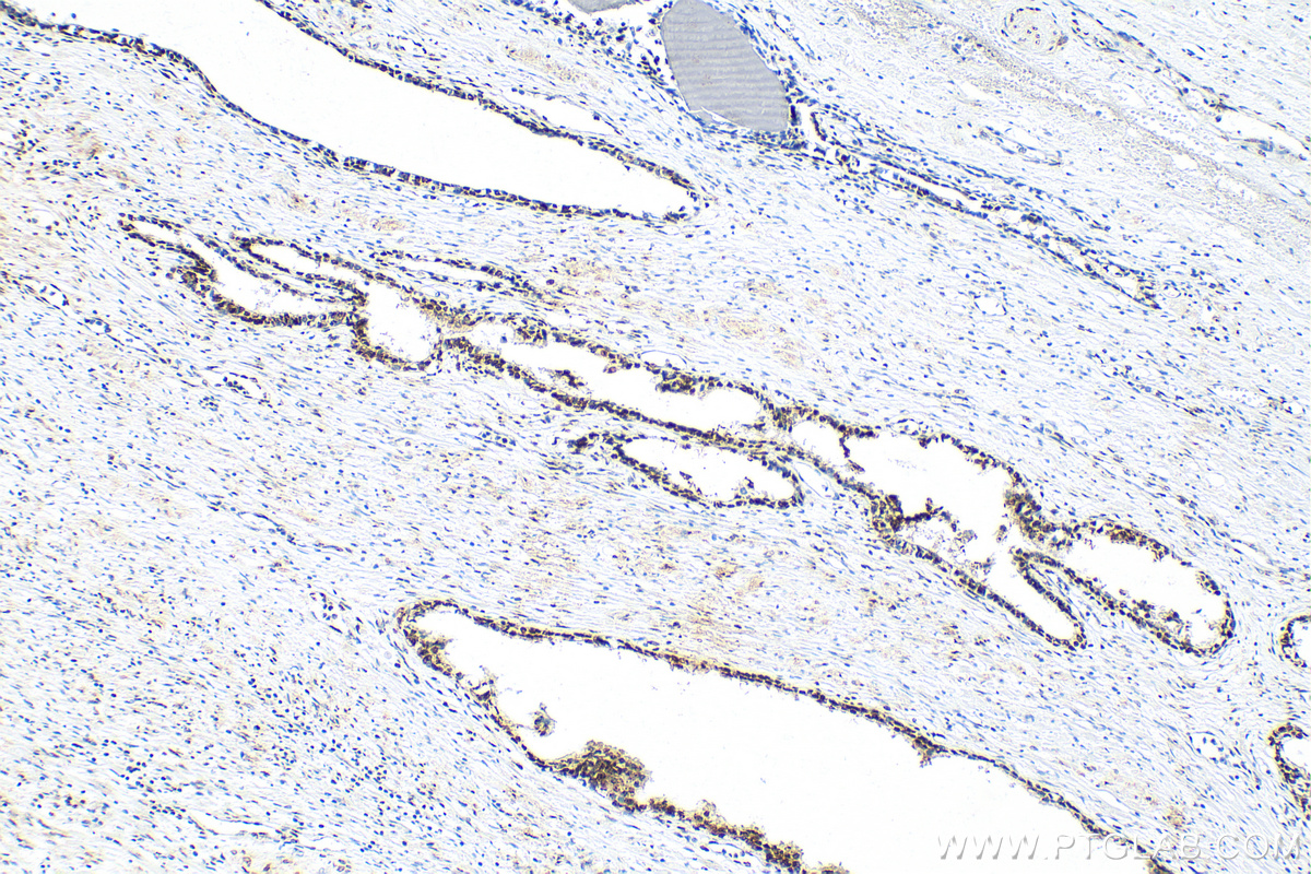 IHC staining of human prostate cancer using 82879-1-RR