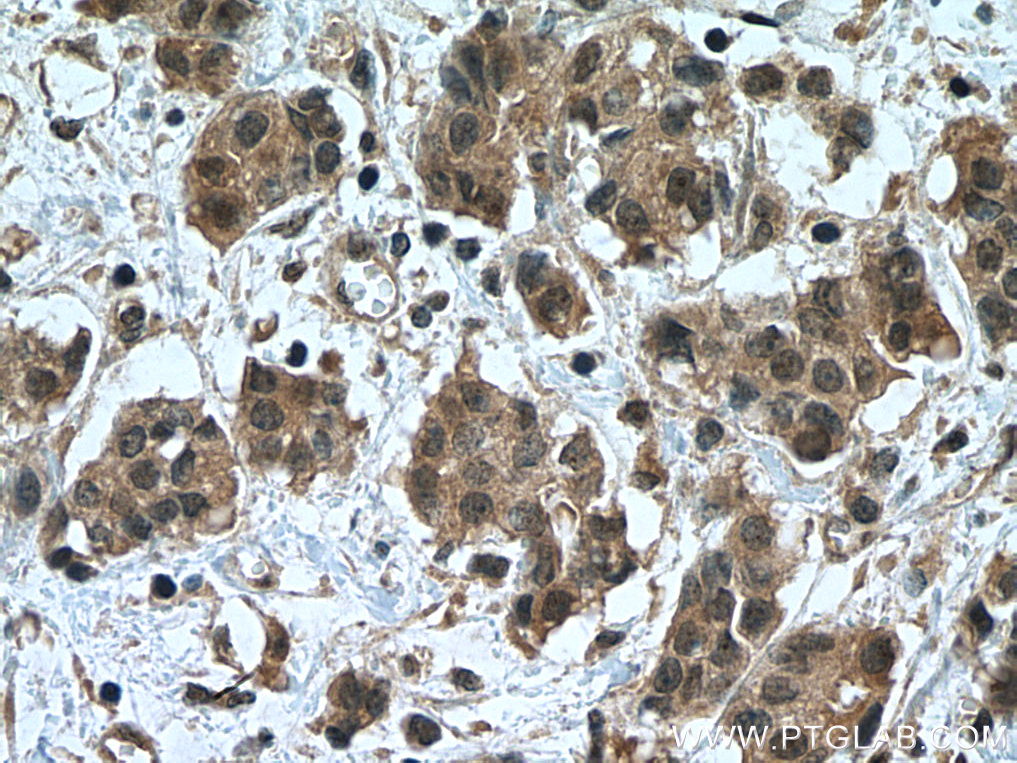 IHC staining of human breast cancer using 20687-1-AP