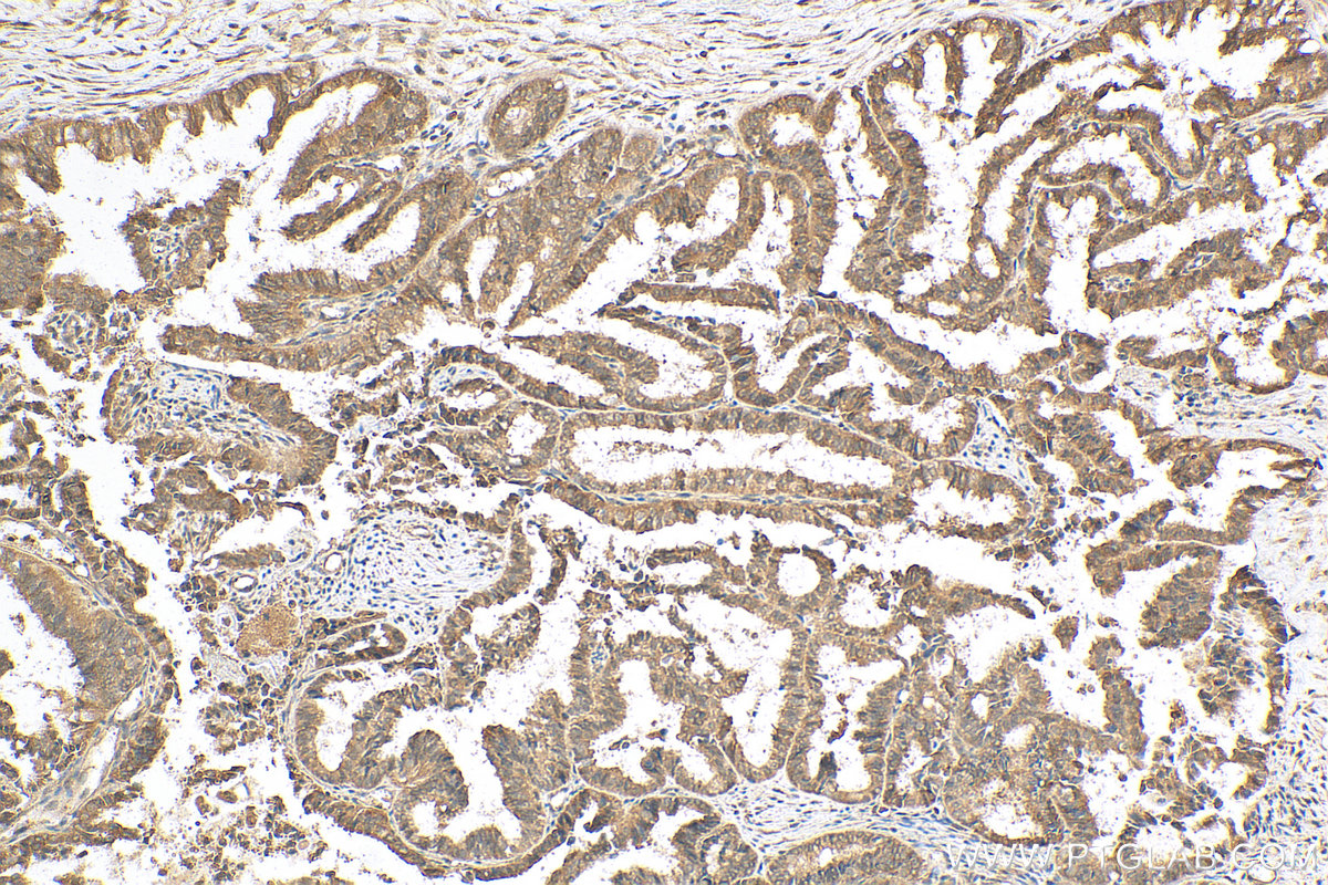 IHC staining of human ovary tumor using 20687-1-AP