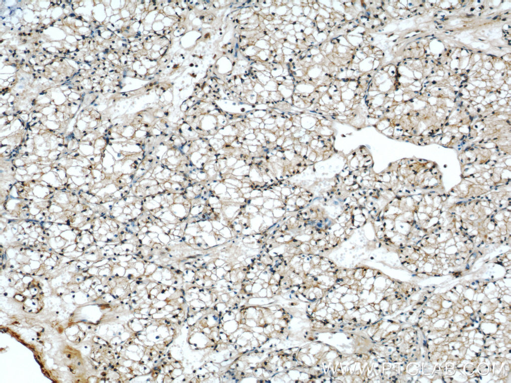 IHC staining of human nephroblastoma using 55449-1-AP