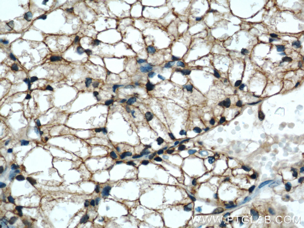 IHC staining of human nephroblastoma using 55449-1-AP