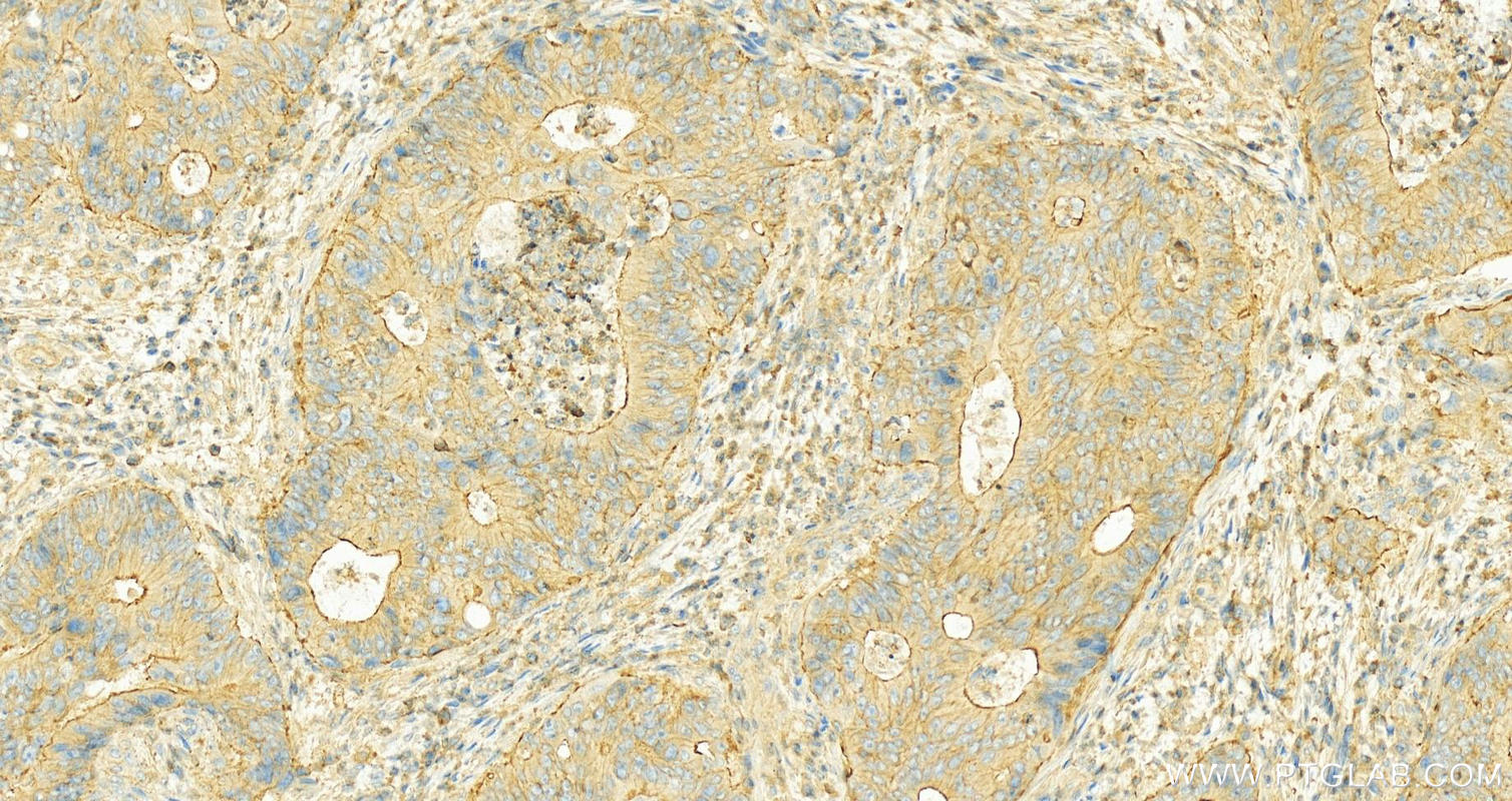 IHC staining of Human colon cancer using 17772-1-AP
