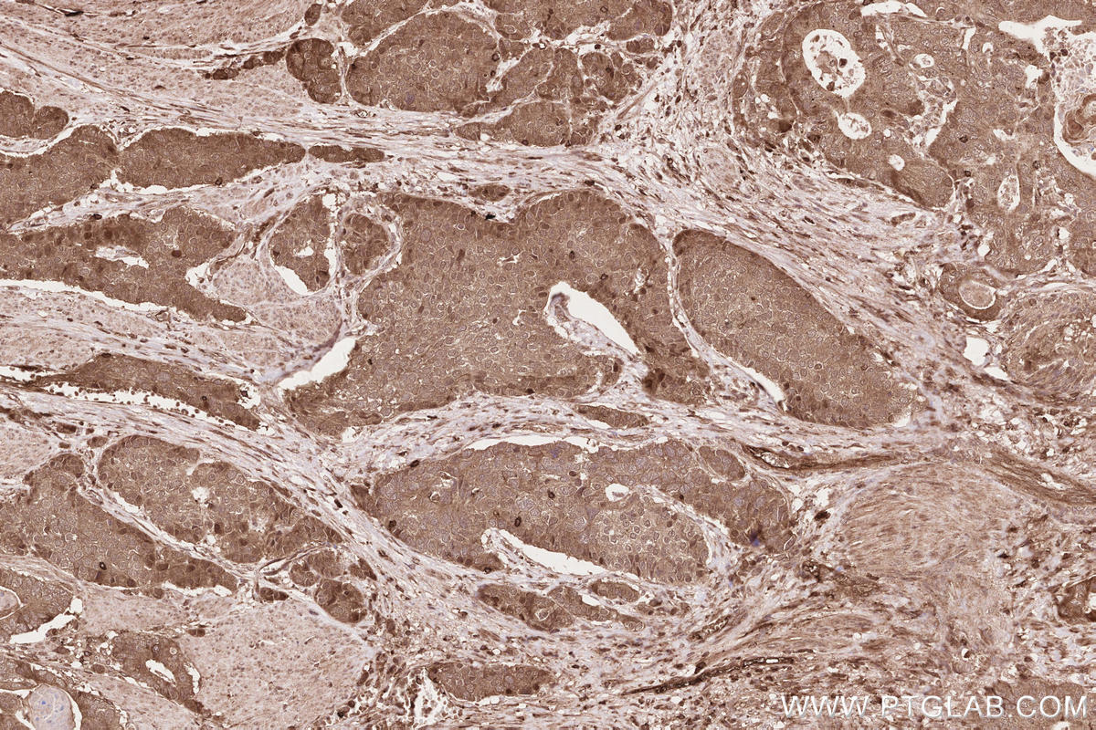 IHC staining of human stomach cancer using 22026-1-AP IHC staining of human stomach cancer using 22026-1-AP