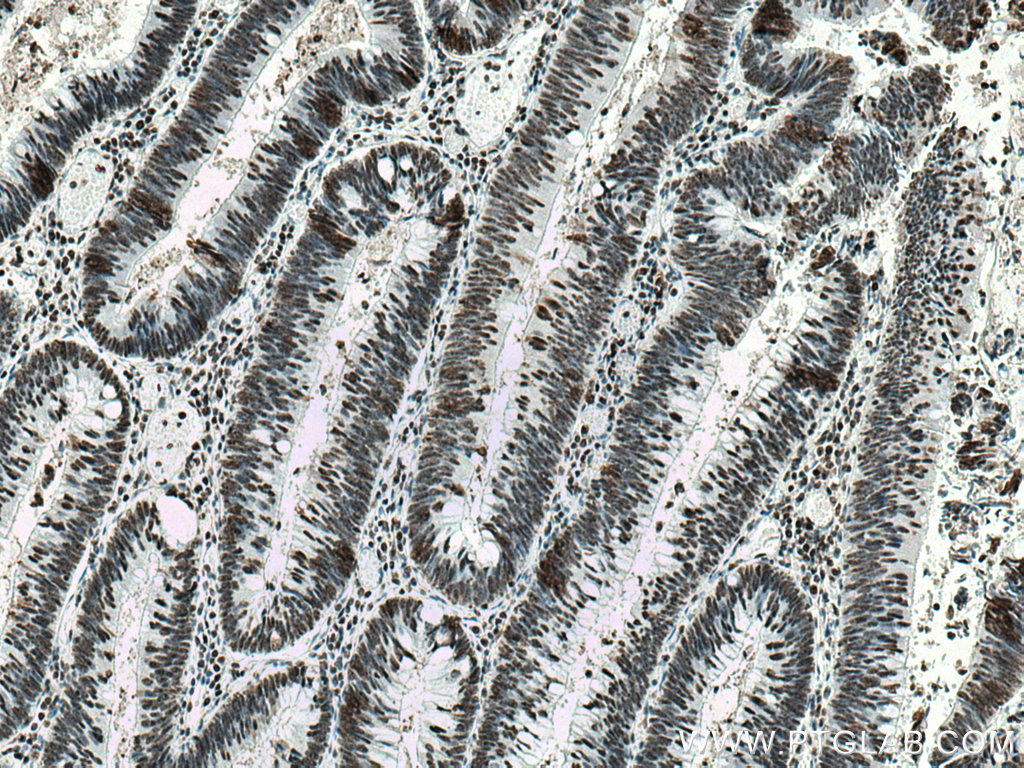 IHC staining of human colon cancer using 10306-1-AP