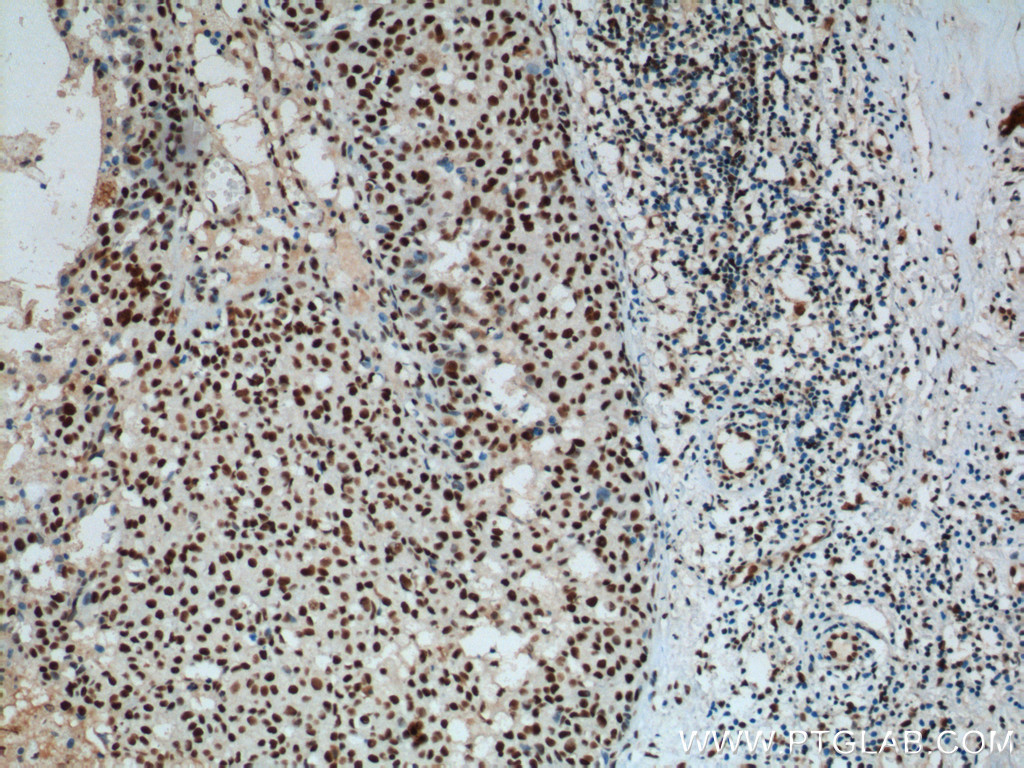 IHC staining of human breast cancer using 60096-1-Ig