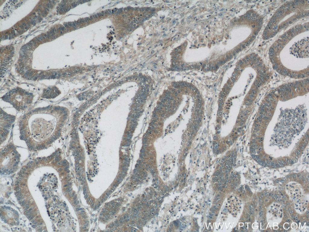 IHC staining of human colon cancer using 25248-1-AP