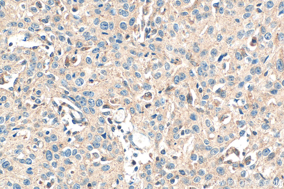 IHC staining of human cervical cancer using 26446-1-AP