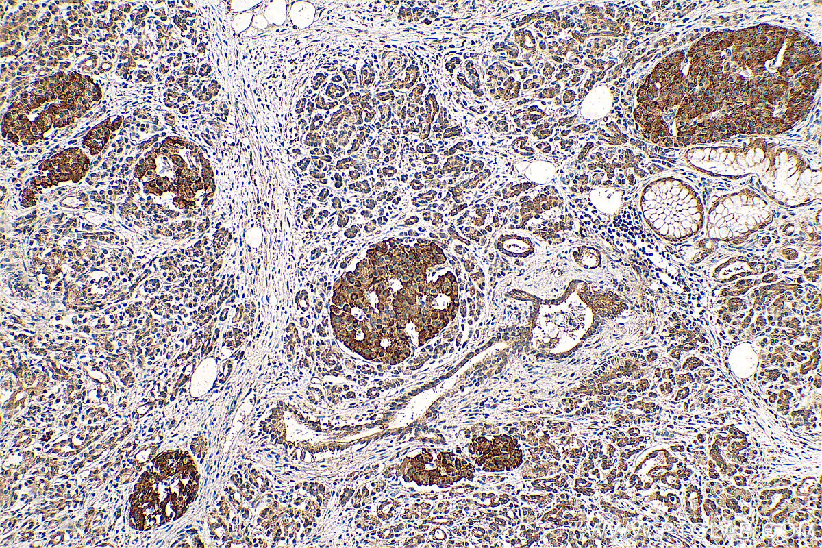 IHC staining of human pancreas cancer using 23609-1-AP