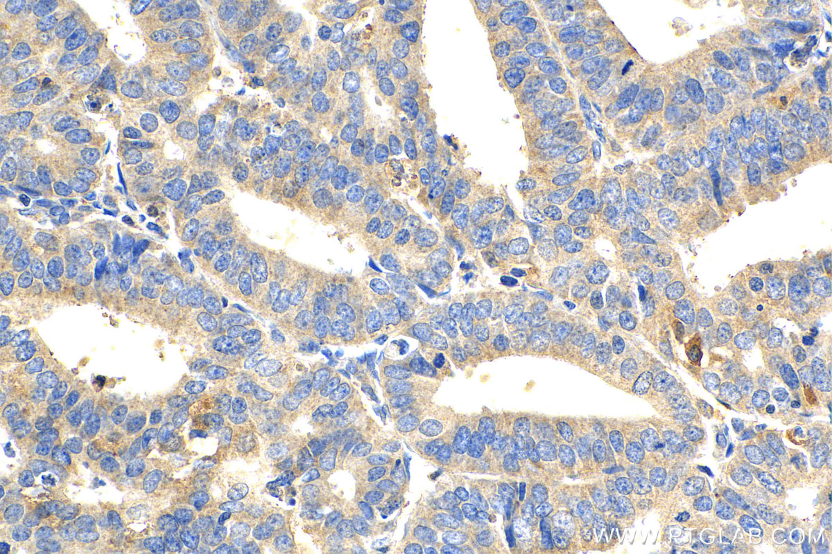 IHC staining of human endometrial cancer using 25085-1-AP