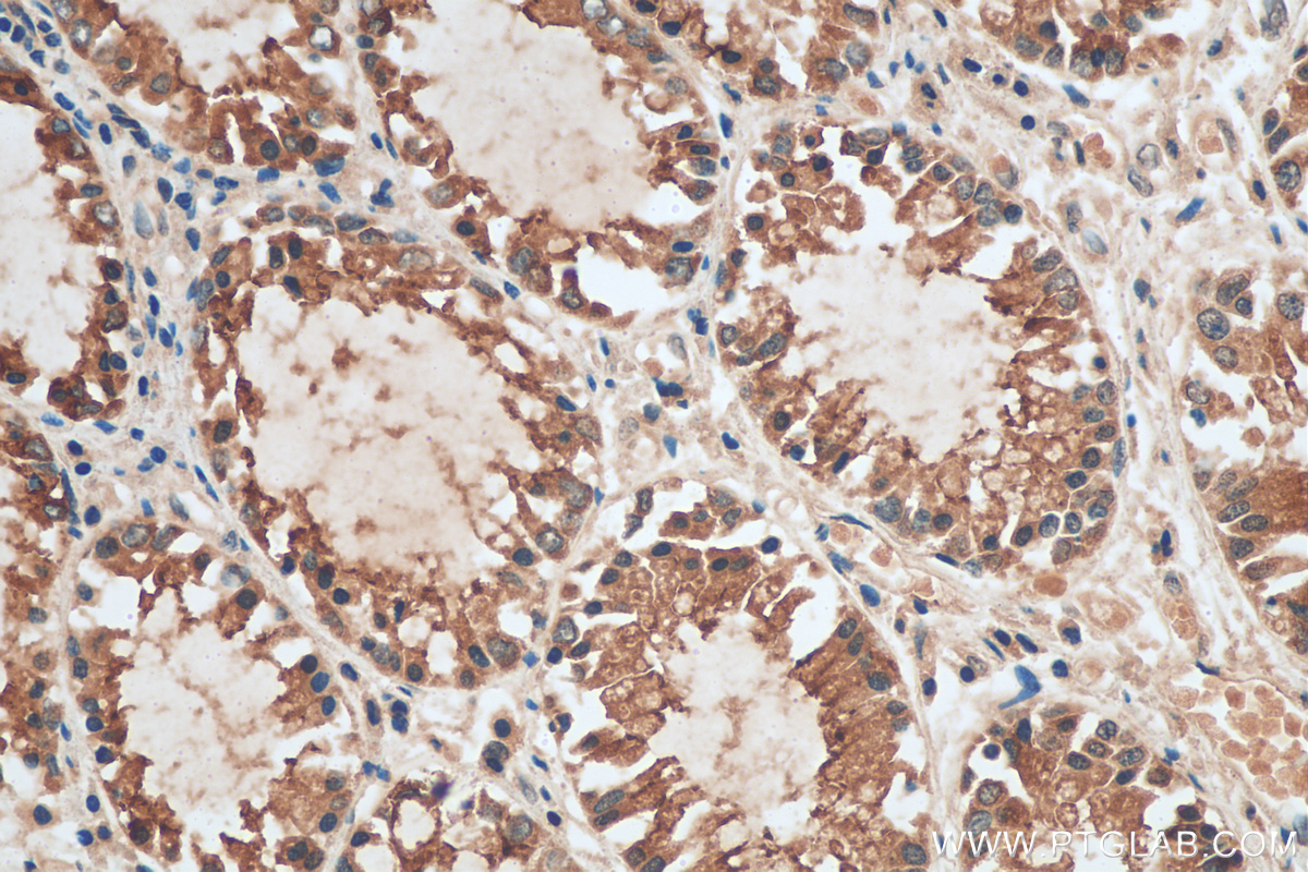 IHC staining of human colon cancer using 11451-1-AP