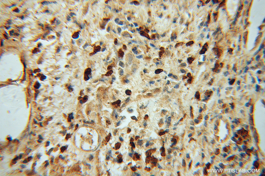 IHC staining of human prostate cancer using 13658-1-AP