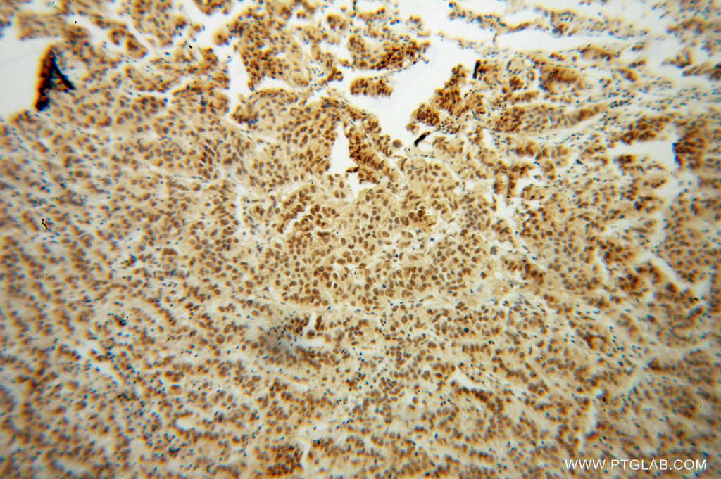 IHC staining of human prostate cancer using 14246-1-AP (same clone as 14246-1-PBS)