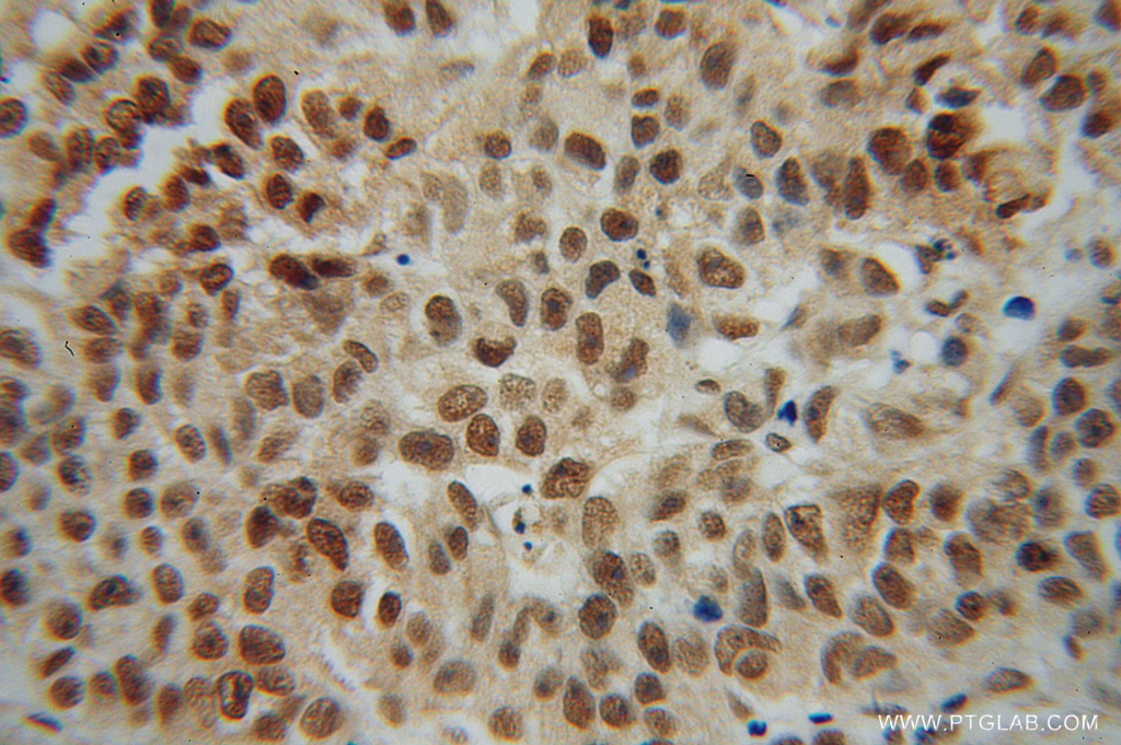 IHC staining of human prostate cancer using 14246-1-AP