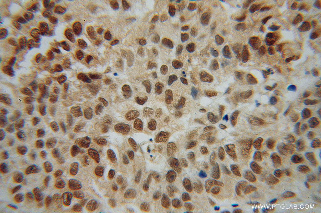 IHC staining of human prostate cancer using 14246-1-AP (same clone as 14246-1-PBS)