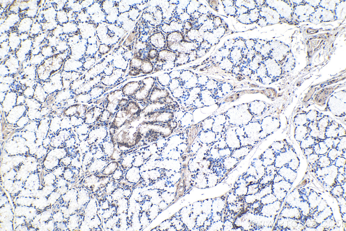 IHC staining of human stomach cancer using 24573-1-AP