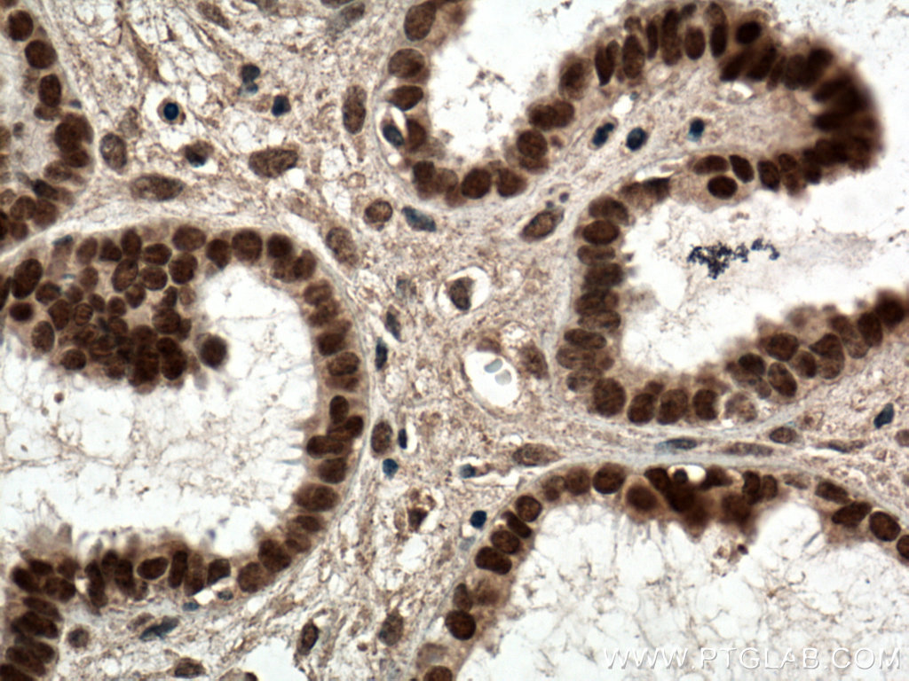 IHC staining of human ovary tumor using 60117-2-Ig (same clone as 60117-2-PBS)