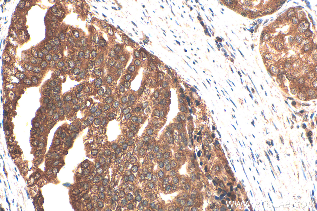 IHC staining of human prostate cancer using 66878-1-Ig