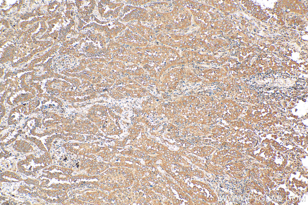 IHC staining of human lung cancer using 14588-1-AP