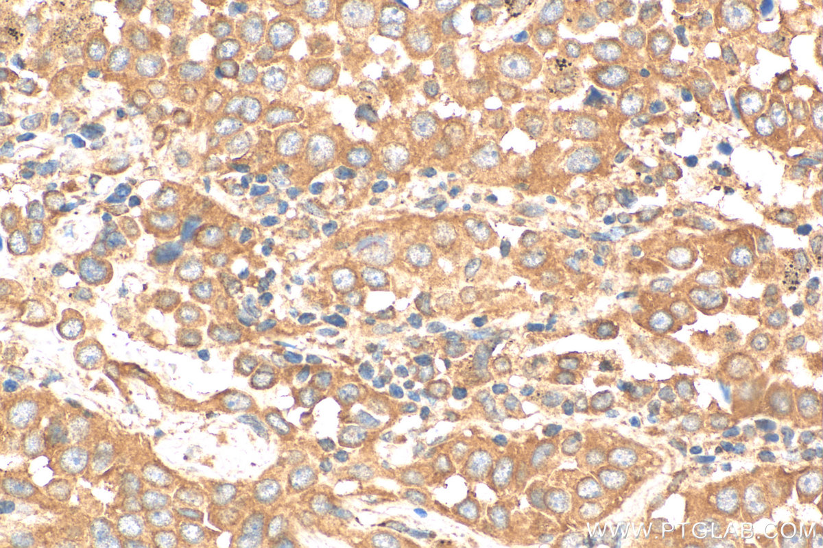 IHC staining of human lung cancer using 14588-1-AP