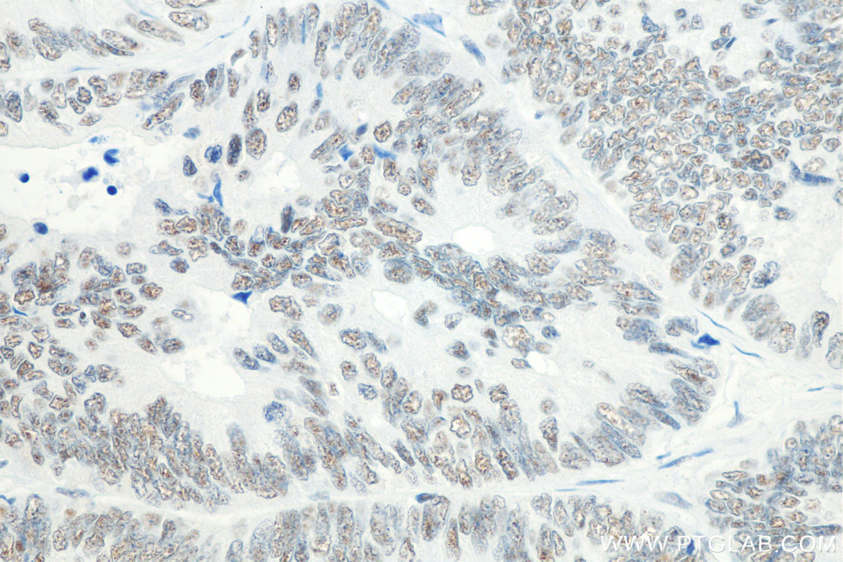 IHC staining of human colon cancer using 66832-1-Ig