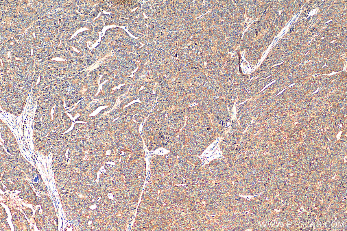 IHC staining of human ovary tumor using 80593-1-RR